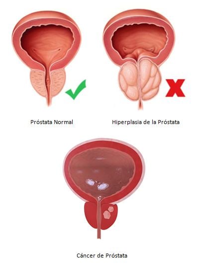 cancer prostata